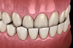 Illustration of an underbite